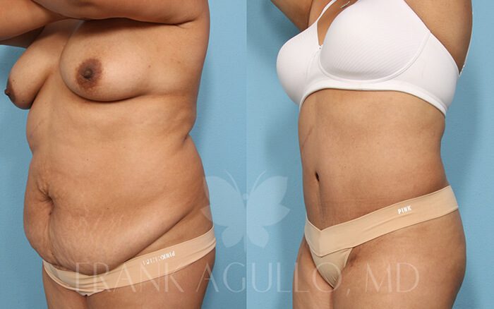 Tummy Tuck Before and After 20