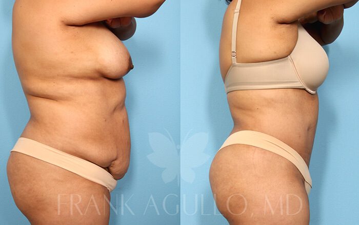 Tummy Tuck Before and After 19