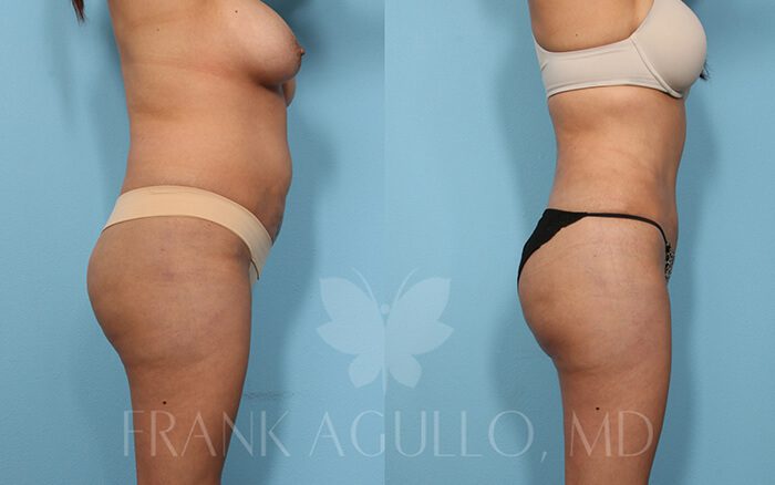 Tummy Tuck Before and After 18