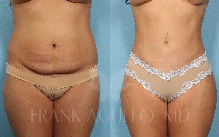 Tummy Tuck Before and After 17