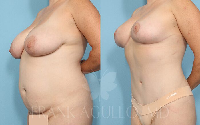 Tummy Tuck Before and After 16