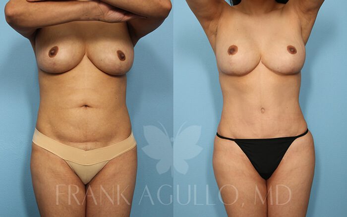 Tummy Tuck Before and After 15