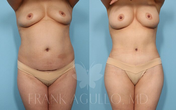 Tummy Tuck Before and After 12