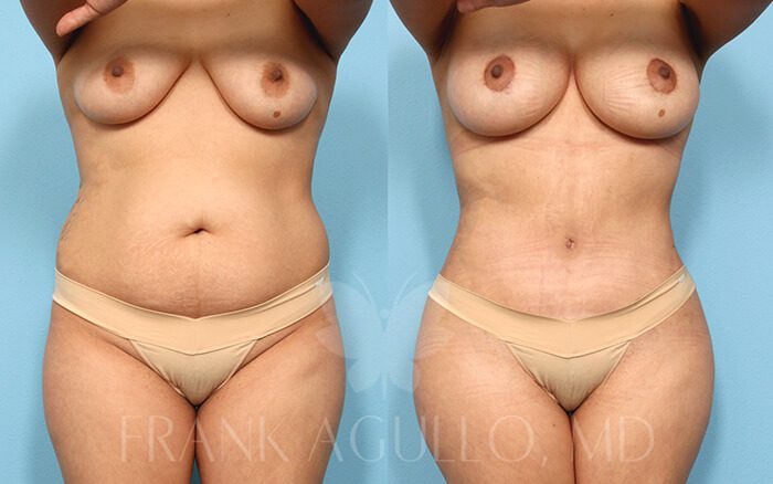 Tummy Tuck Before and After 11