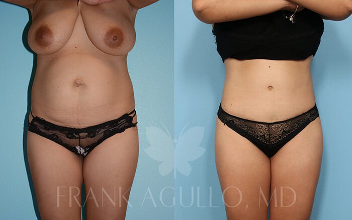 Tummy Tuck Before and After 10