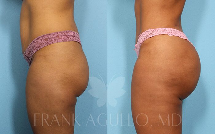 Tummy Tuck Before and After 9