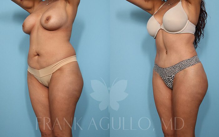 Tummy Tuck Before and After 7