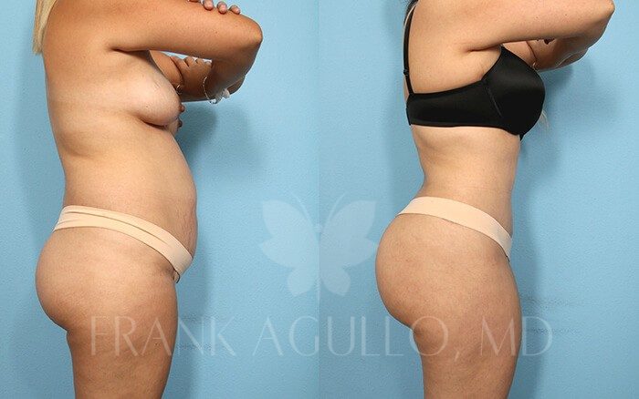 Tummy Tuck Before and After 3