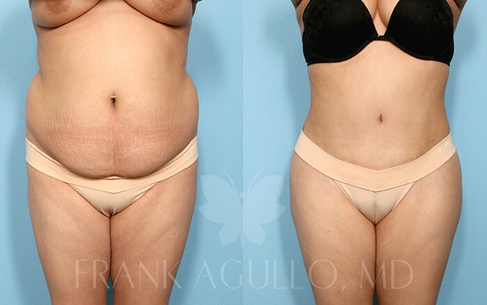 Tummy Tuck Before and After 9