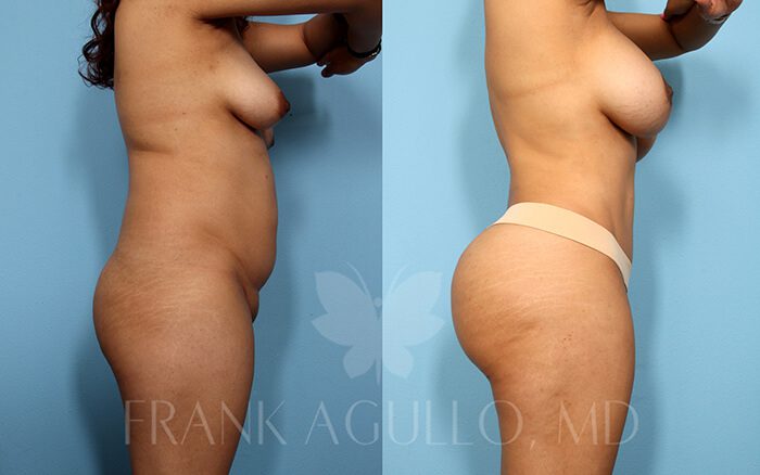 Tummy Tuck Before and After 7