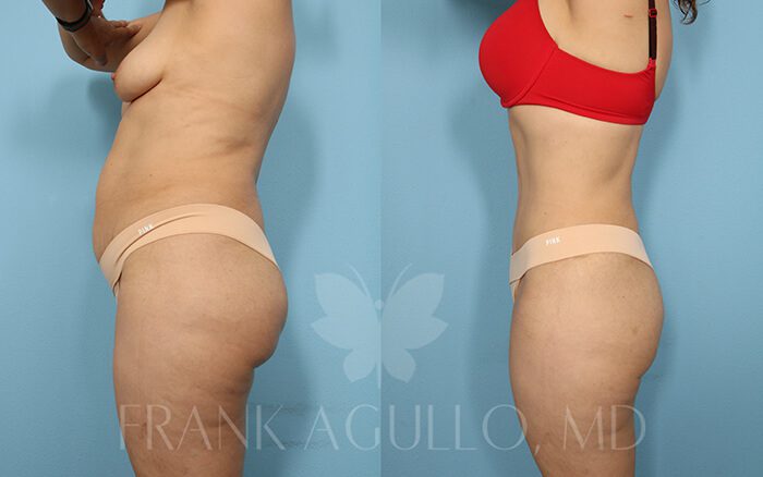 Tummy Tuck Before and After 6