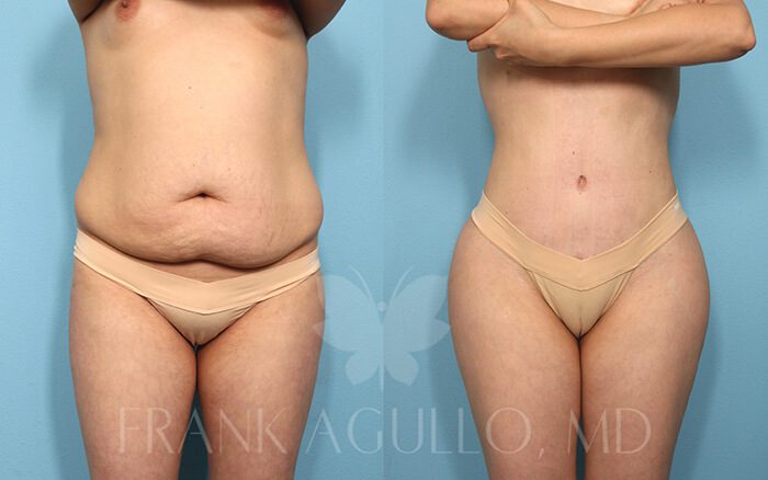 Tummy Tuck Before and After 3