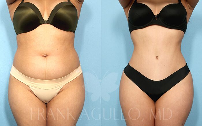 Tummy Tuck Before and After 2