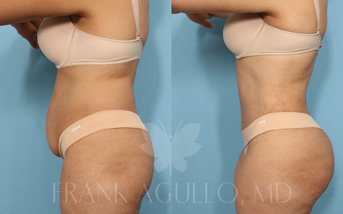 Tummy Tuck Before and After 19