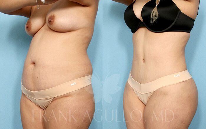 Tummy Tuck Before and After 18