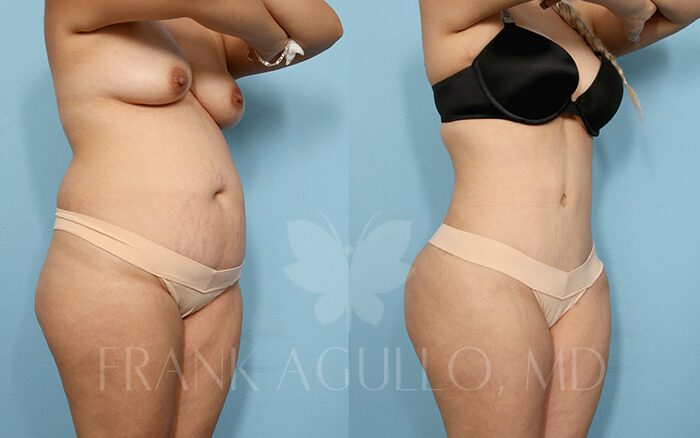 Tummy Tuck Before and After 2
