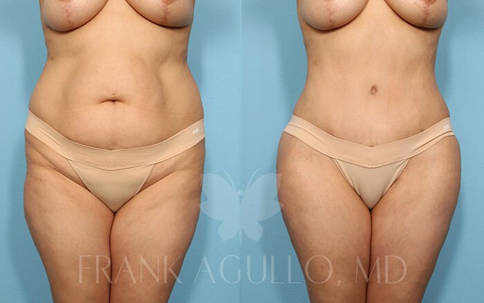 Tummy Tuck Before and After 17