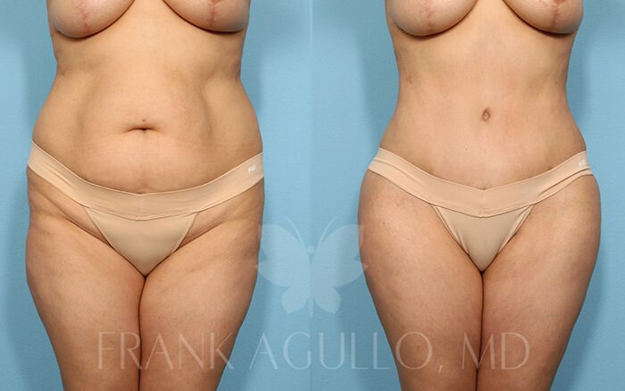 Tummy Tuck Before and After 2