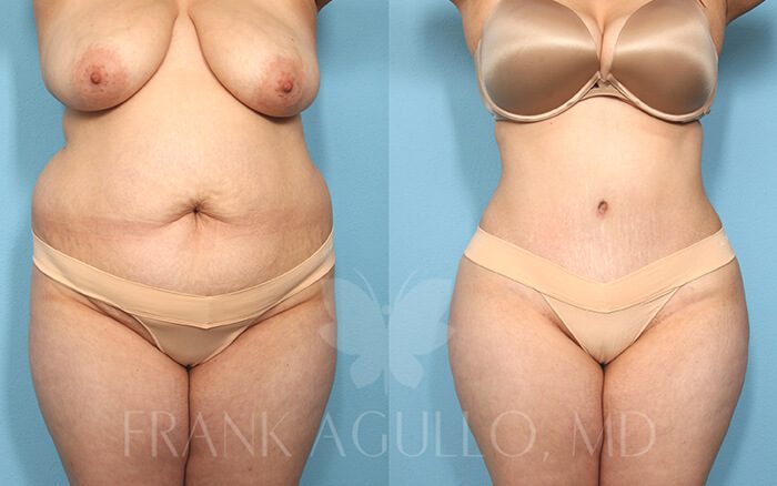 Tummy Tuck Before and After 16