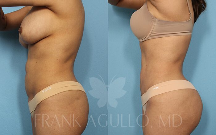 Tummy Tuck Before and After 15