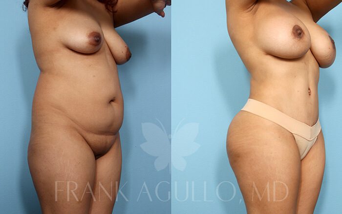 Tummy Tuck Before and After 14