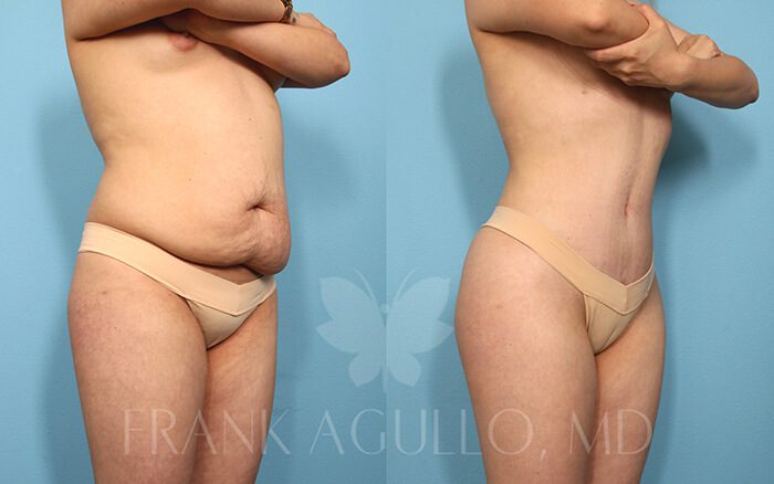 Tummy Tuck Before and After 12