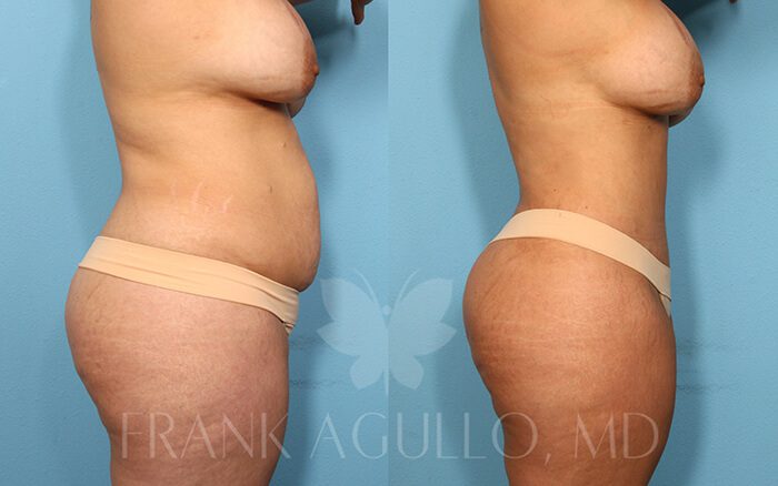 Tummy Tuck Before and After 3