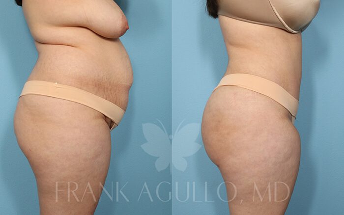 Tummy Tuck Before and After 8