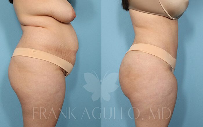 Tummy Tuck Before and After 8