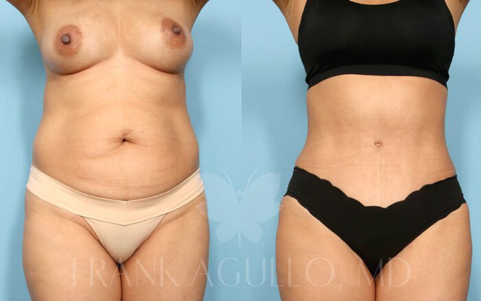 Tummy Tuck Before and After 7