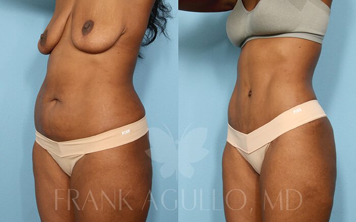 Tummy Tuck Before and After 2
