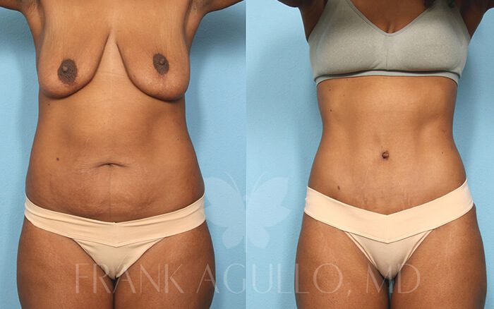 Tummy Tuck Before and After 6