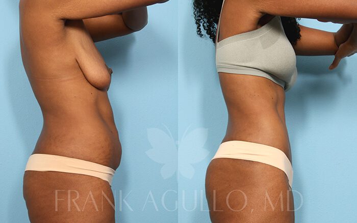 Tummy Tuck Before and After 3
