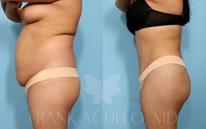 Tummy Tuck Before and After 5