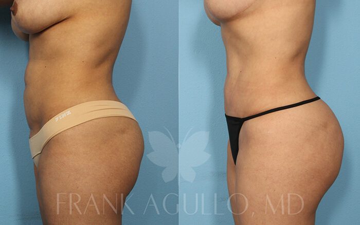 Tummy Tuck Before and After 4