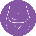 Circumferential Tummy Tuck