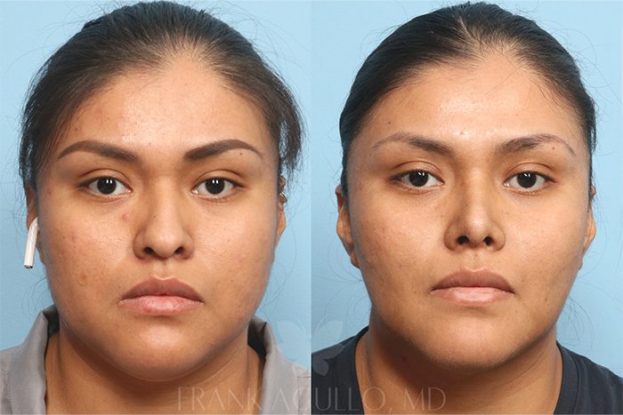 Buccal Fat Pad Removal Before and After 1