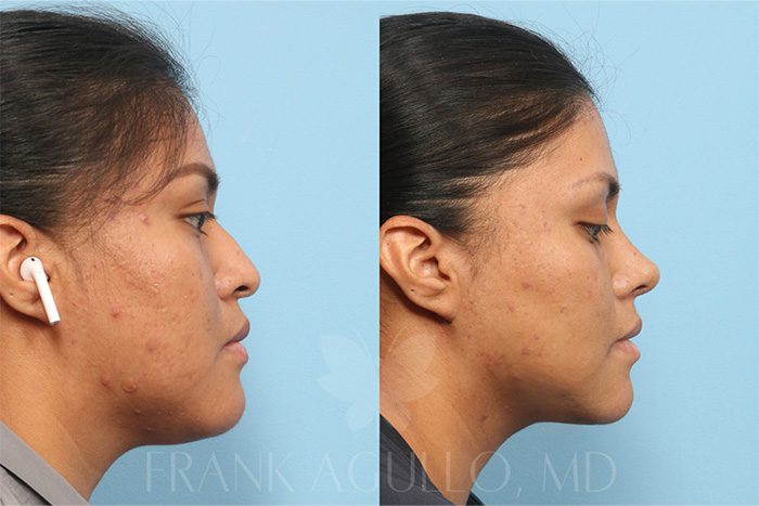 Buccal Fat Pad Removal Before and After 2