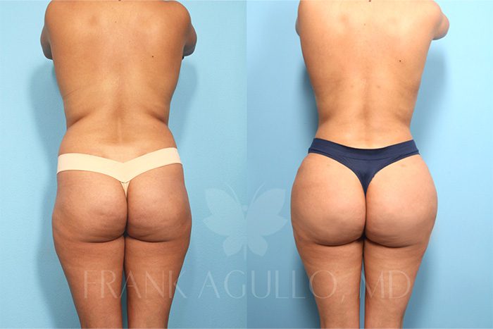 Brazilian Butt Lift Before and After 6