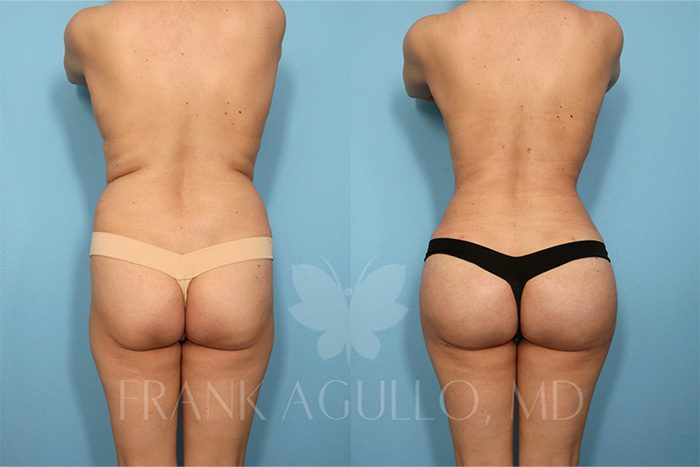 Brazilian Butt Lift Before and After 5