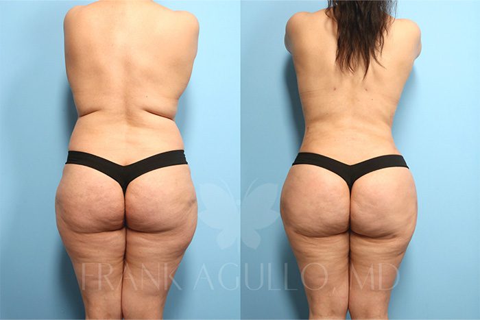 Brazilian Butt Lift Before and After 4