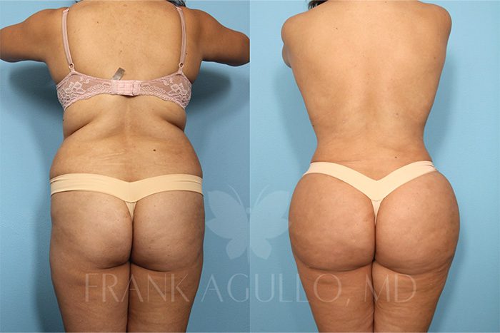 Brazilian Butt Lift Before and After 3