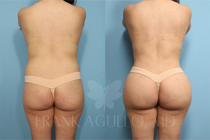 Brazilian Butt Lift Before and After 2