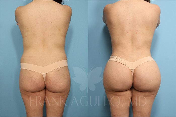 Brazilian Butt Lift Before and After 11