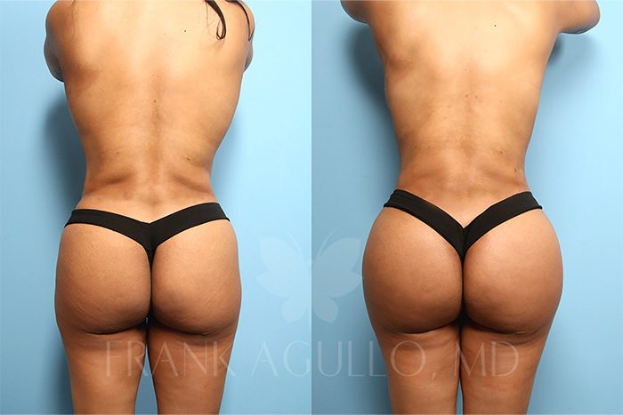 Brazilian Butt Lift Before and After 1