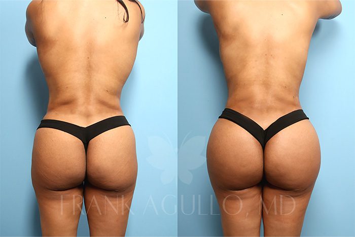 Brazilian Butt Lift Before and After 10