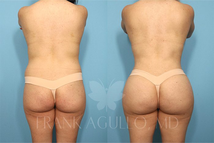 Brazilian Butt Lift Before and After 9