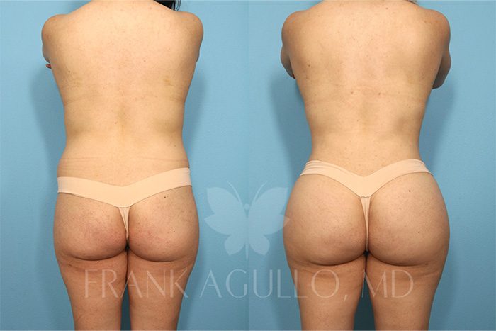 Brazilian Butt Lift Before and After 18