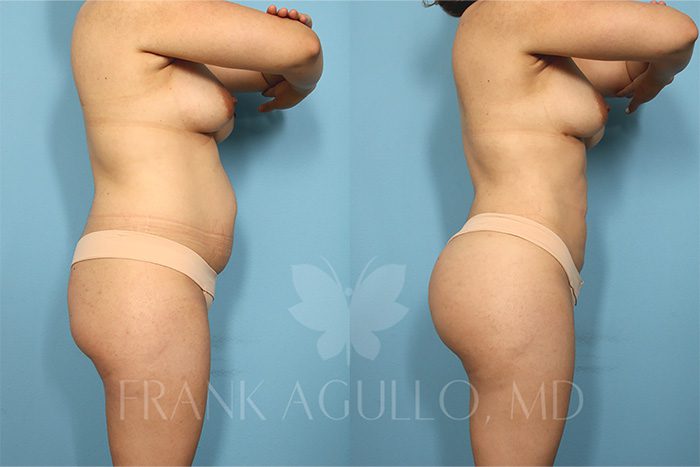Brazilian Butt Lift Before and After 2