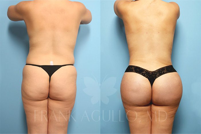 Brazilian Butt Lift Before and After 8